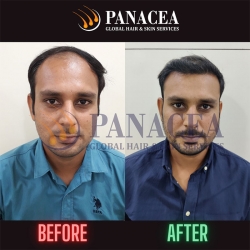 Hair Transplant Repair Before and After Result in Delhi